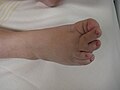 The right foot of a person with Langer-Giedion syndrome showing the characteristic features