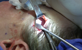 Upper incision during a mid facelift