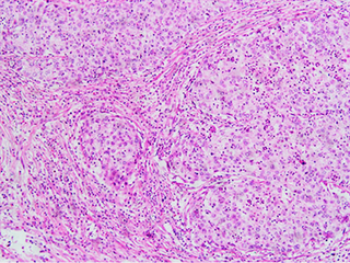 Invasive squamous cell carcinoma of the cervix is characterized by infiltration as irregular anastomosing nests or single cells.[63] This case is poorly differentiated. H&E stain.