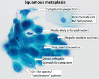 Cytology of squamous metaplasia of the cervix, with typical features. Pap stain.