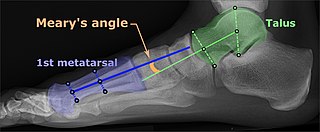 Meary's angle