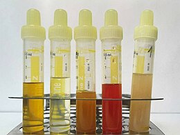 A variety of urine samples in a test tube rack. From left to right, the color and clarity of each sample is: clear and dark yellow; clear and pale yellow; orange and cloudy; red and cloudy; pinkish-yellow and cloudy.