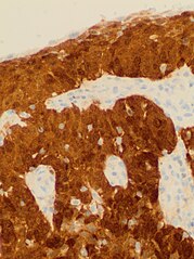 Cervical squamous cell carcinoma generally shows diffuse staining of both nuclei and cytoplasm on p16 immuno- histochemistry (except verrucous variant).[64]