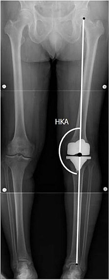 HKA: Hip-knee-ankle angle, which is ideally between 3° varum to 3° valgum from a right angle.[62]