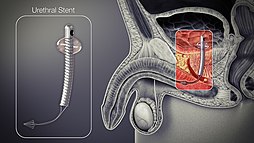 3D Medical Animation still shot of Urethral Stent