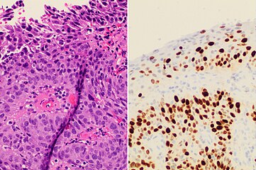 Invasive cervical squamous cell carcinoma on H&E histopathology and Ki-67 immunohistochemistry. The latter correlates well with the degree and level of dysplasia.[65]