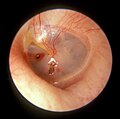 這個左耳鼓膜上的橢圓形穿孔是被人拍打耳朵造成的。