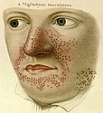 The earliest illustration of tuberous sclerosis