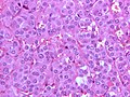 Salt-and-pepper chromatin (pheochromocytoma). H&E stain.