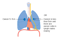 Stage IIA lung cancer