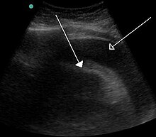 A large anechoic (black) pericardial effusion as seen on ultrasound. Closed arrow: the heart, open arrow: the effusion