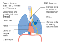 Stage IIIA lung cancer, if there is one feature from the list on each side