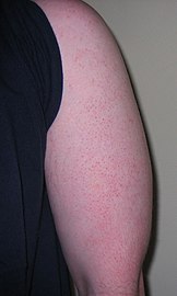 Keratosis Pilaris on Back of Upper Arm (Moved from Wikimedia Commons: Shared in Keratosis pilaris)