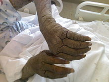 Diffuse thickening of the skin over an adult's bilateral arms and fingers