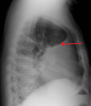A pleural effusion as seen on lateral upright chest x-ray