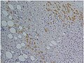 Immunohistochemical staining of trophozoites (brown) using specific anti–Entamoeba histolytica macrophage migration inhibitory factor antibodies in a patient with amoebic colitis.