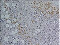 Immunohistochemical staining of trophozoites (brown) using specific anti–Entamoeba histolytica macrophage migration inhibitory factor antibodies in a patient with amebic colitis