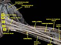 Brachial plexus.Deep dissection. Anterolateral view