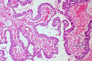 Papillary: Protuberances of epithelioid cells around fibrovascular cores.