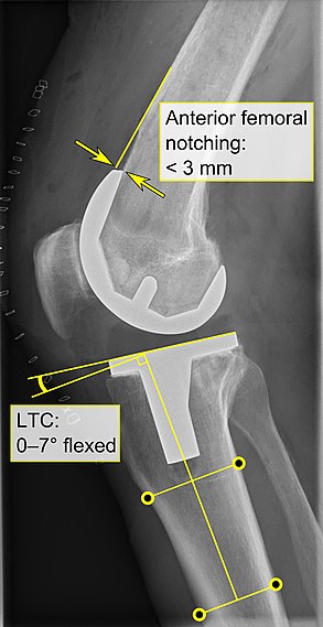 - Anterior femoral notching (the femoral component causing reduced thickness of the distal femur anteriorly), seems to cause an increased risk of fractures when exceeding about 3 mm.[64] - LTC: lateral (or sagittal) tibial component angle, which is ideally positioned so that the tibia is 0–7° flexed compared to at a right angle with the tibial plate.[63]