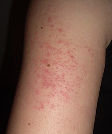 Keratosis pilaris arm (Moved from Wikimedia Commons: Shared in Keratosis pilaris)