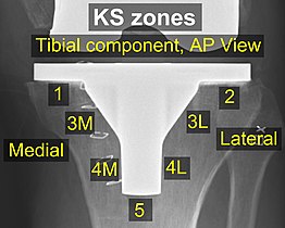 KS zones, anteroposterior (AP) view.[46]