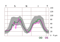 TSNIT graph