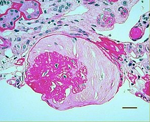 Light micrograph showing hypertensive glomerular lesion of hypertensive nephropathy: global glomerular collapse and filling of Bowman's space with a lightly staining collagenous material.