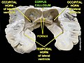 Corpus callosum