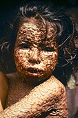 Child with Smallpox Bangladesh (1973)