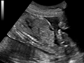 胎儿超声，显示脐尿管连接膀胱至肚脐。