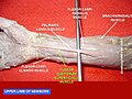 Flexor digitorum superficialis muscle