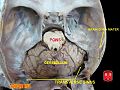 Transverse sinuses