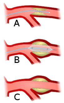 Angioplasty (pictured) and stenting are two endovascular treatments employed by the vascular surgeon.