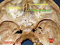 Base of skull - crista galli, cribriform plate and foramen cecum