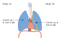 Stage IA and IB lung cancer