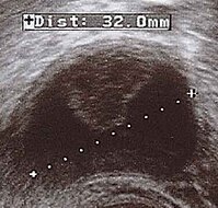 Corpus luteum cyst with bleeding