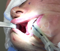 Lower incision during a mid facelift