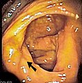 盲肠的直肠镜（英语：Colonoscopy）影像，前面箭头部分即为回盲瓣