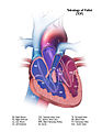 Tetralogy of Fallot