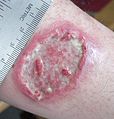 Cutaneous leishmaniasis ulcer on left forearm