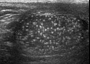 Fig. 25. Testicular microlithiasis. Multiple hyperechoic foci without acoustic shadow presenting as a starry sky appearance is seen in the testis.[citation needed]