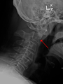A fracture of the base of the dens as seen on plain X-ray