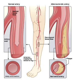 Illustration of atherosclerosis causing arterial obstruction which clinically presents at peripheral artery disease.