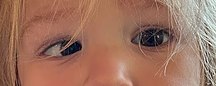 A child with accommodative esotropia affecting the right eye. The left eye points forwards while the right eye points inward towards the nose.