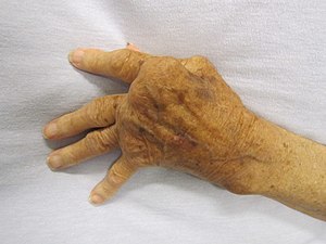 晚期类风湿关节炎的老人手部照片