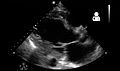 Ultrasound showing severe systolic heart failure[71]