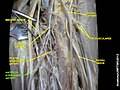 Anterior interosseous artery