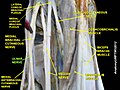 Brachial plexus with characteristic M, ulnar nerve labeled.