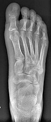 Left big toe joint shifted in sideway due to overcorrection
